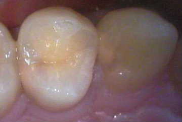 虫歯1-症例A-1