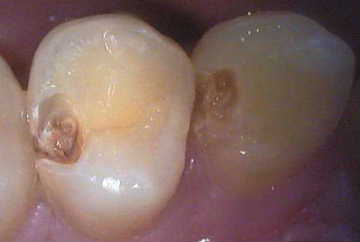 虫歯1-症例A-2