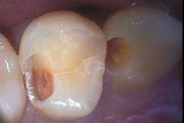 虫歯1-症例A-3