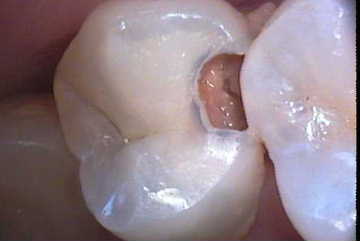 虫歯1-症例B-1