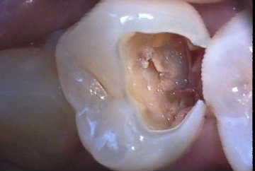 虫歯1-症例B-2