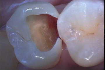 虫歯1-症例B-3