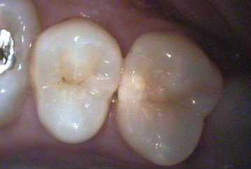 虫歯1-症例C-1