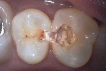 虫歯1-症例C-2