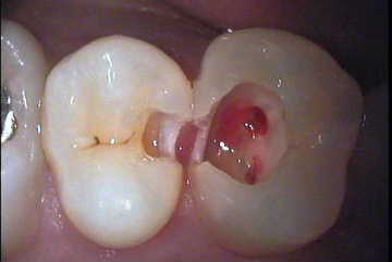 虫歯1-症例C-3