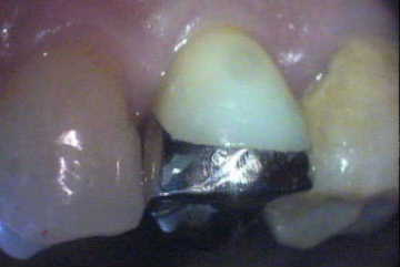 虫歯の治療②