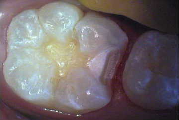 虫歯の治療②