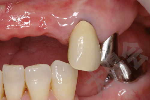 虫歯の治療③