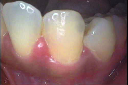 歯周病①A-1