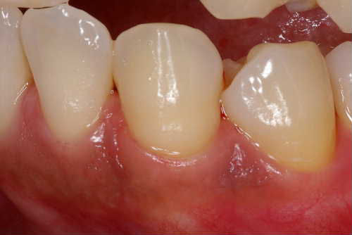 歯周病①A-2