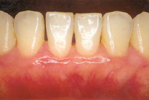 歯周病①B-2