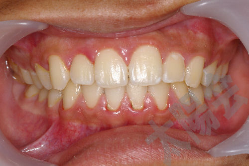歯周病③-1