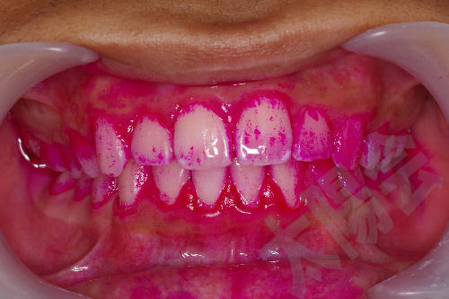 歯周病③-3