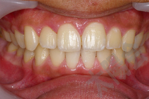 歯周病③-5