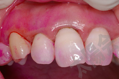 歯周病/SRP-1