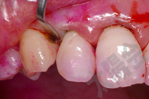 歯周病/SRP-4