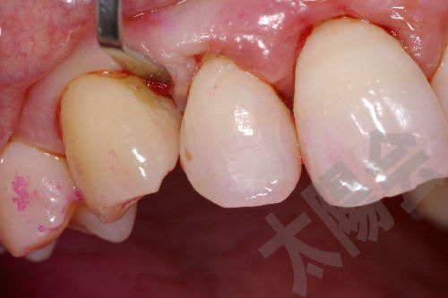 歯周病/SRP-8