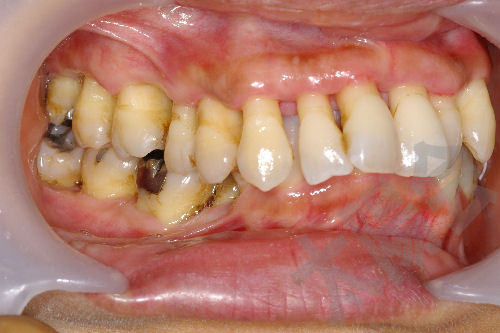歯周病/歯周外科①-10