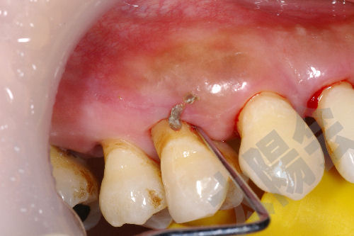 歯周病/歯周外科①-2