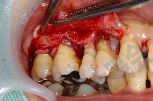 歯周病/歯周外科①-3