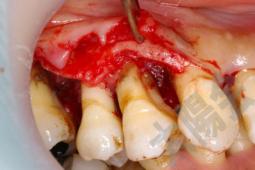 歯周病/歯周外科①-4