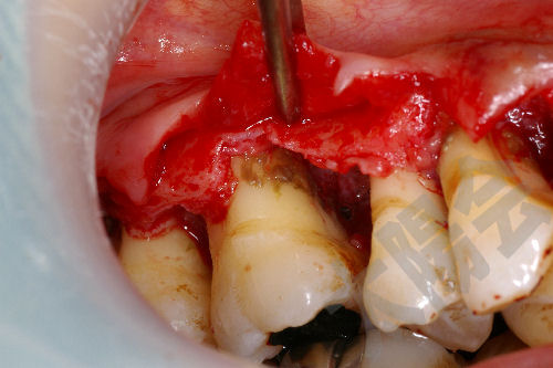 歯周病/歯周外科①-5