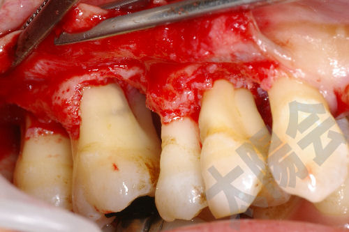 歯周病/歯周外科①-6