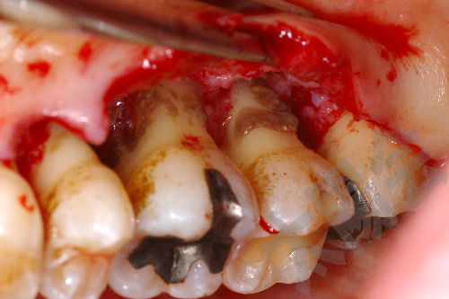 歯周病/歯周外科①-7