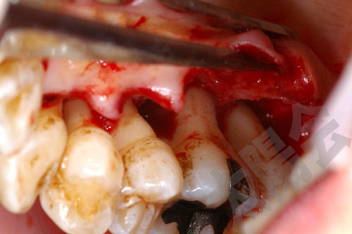 歯周病/歯周外科①-8