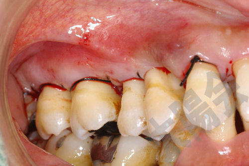 歯周病/歯周外科①-9