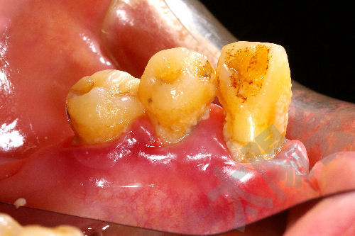 歯周外科②-2
