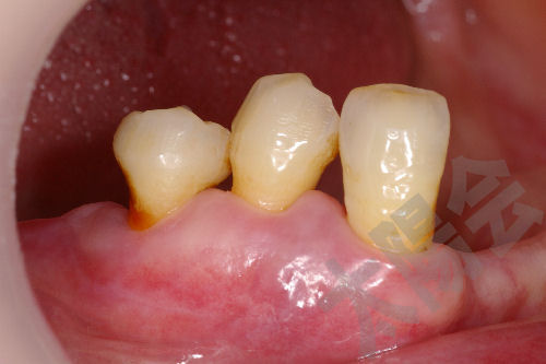 歯周外科②-3