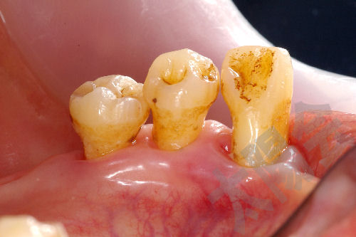 歯周外科②-4