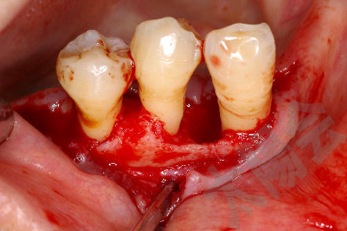 歯周外科②-5