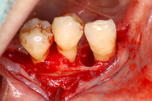 歯周外科②-6