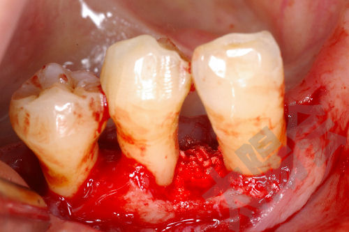 歯周外科②-7