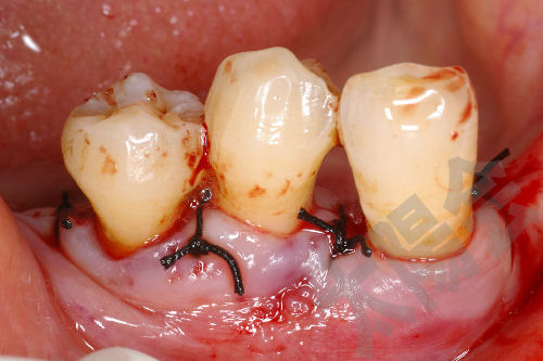 歯周外科②-9