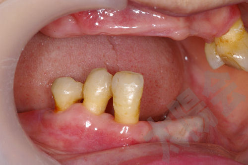 歯周外科②-10