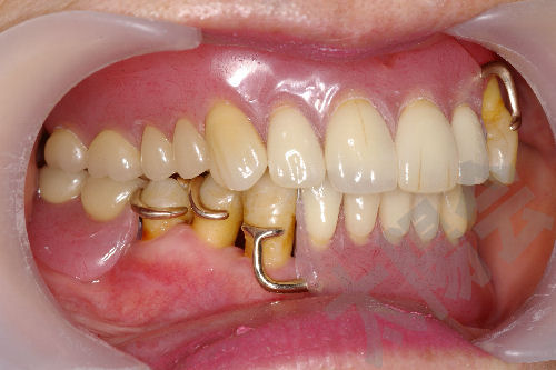 歯周外科②-11