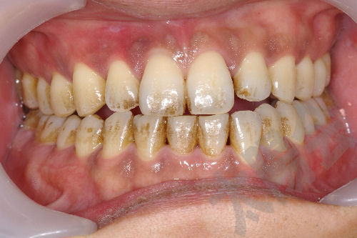 審美歯科①-1