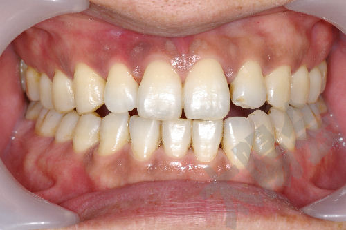 審美歯科①-2